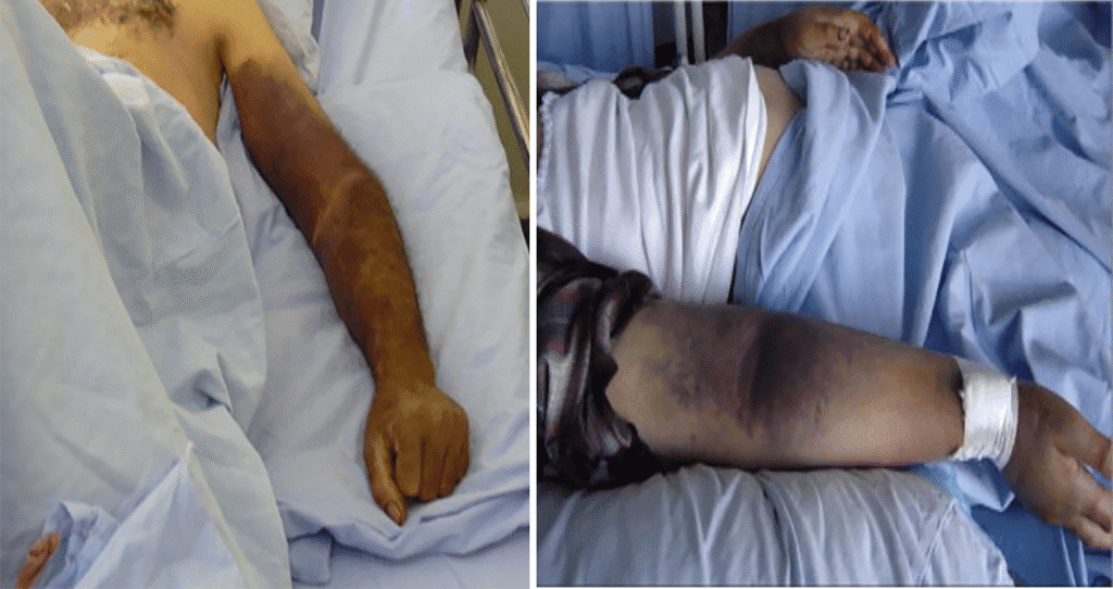 Illustration of hemorrhagic symptoms in Crimean-Congo Hemorrhagic Fever, including petechiae, ecchymoses, bleeding gums, and hematuria