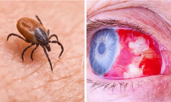 Crimean-Congo Hemorrhagic Fever Virus: Virology, Transmission, Symptoms, and Prevention