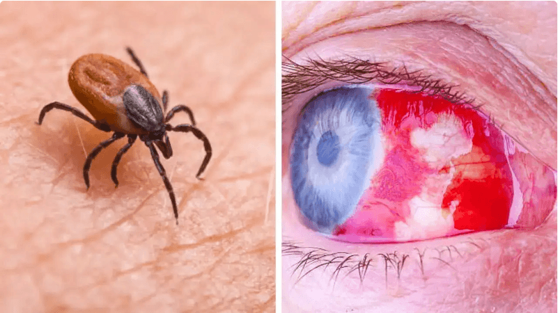 Crimean-Congo Hemorrhagic Fever Virus: Virology, Transmission, Symptoms, and Prevention Crimean-Congo Hemorrhagic Fever Virus: Virology, Transmission, Symptoms, and Prevention